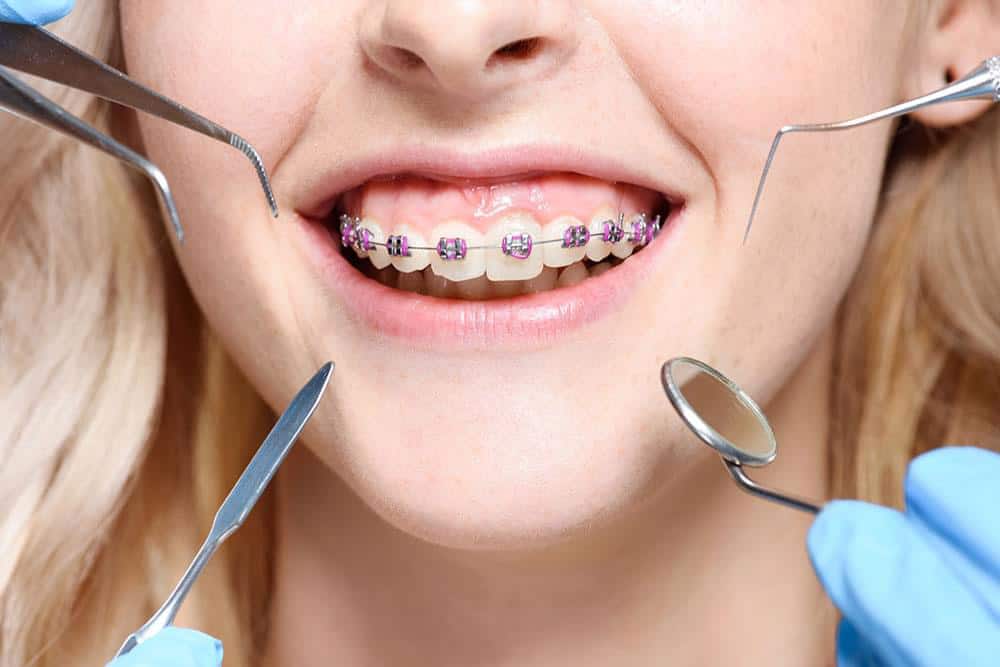 وزن اجزای ارتودنسی