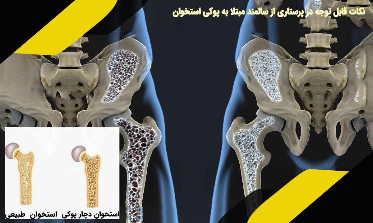نکات قابل توجه در پرستاری از سالمند مبتلا به پوکی استخوان
